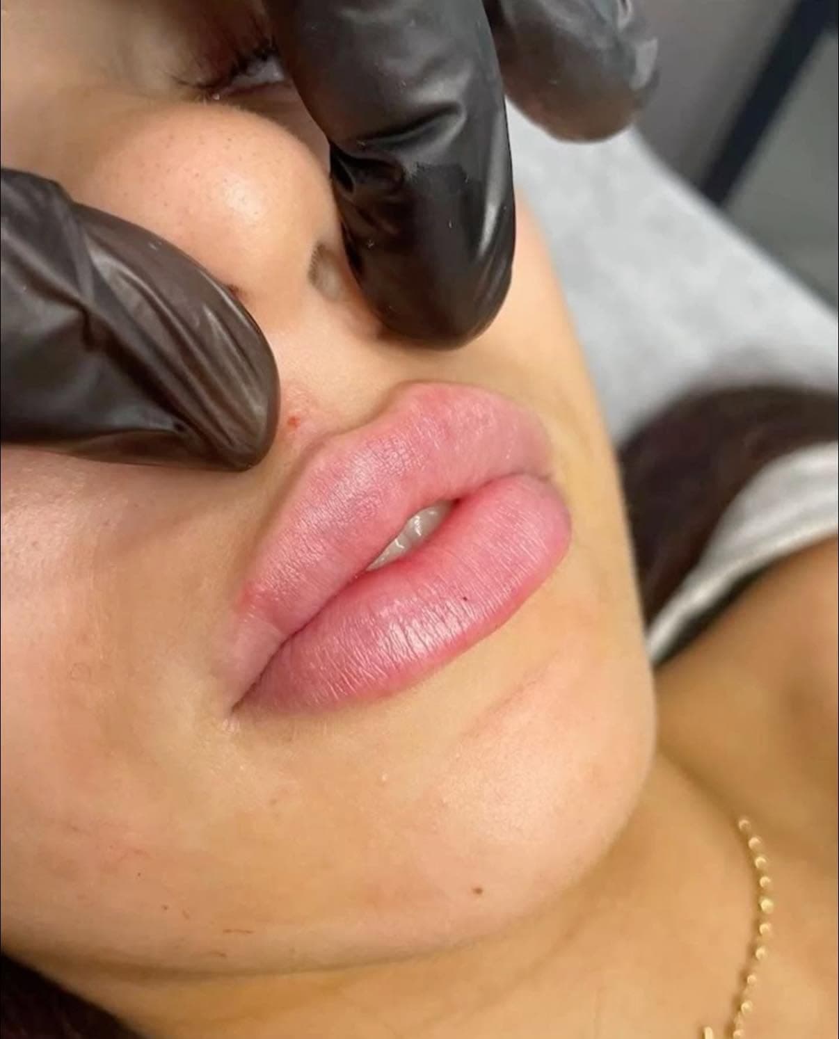 Close-up of a natural lip enhancement result at Sculpt Beauty Lounge